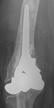Bild zeigt Teilprothese des rechten Ellenbogens. Hier wurden die verschlissenen Anteile des körperfernen Oberarmes ersetzt.