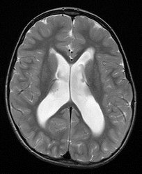 Bild zeigt 3. Röntgenaufnahme eines Schädels / Gehirns