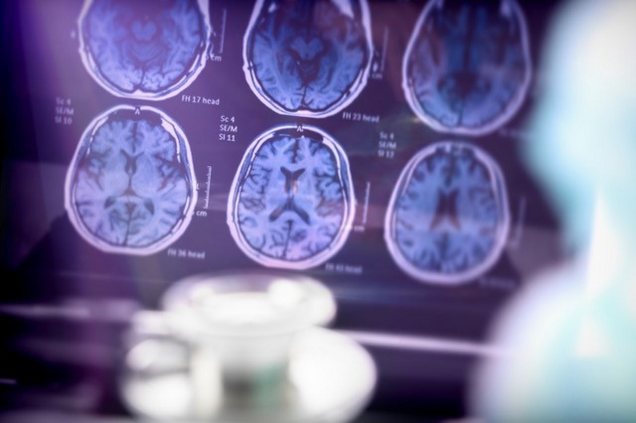 Up-To-Date in der Neurologie