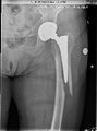 Röntgenbild einer periprothetischen Femurfraktur nach Sturz mit gelockerter Schaftprothese