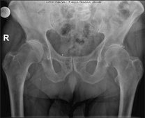 Bild zeigt präop. Planungsbild bei Coxarthrose rechts mehr als links. 