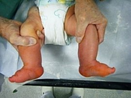 Bild zeigt Füße nach der Gipstherapie