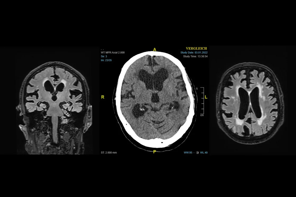 Normaldruck-Hydrocephalus