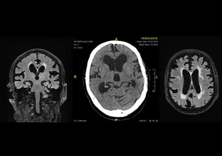 Normaldruck-Hydrocephalus