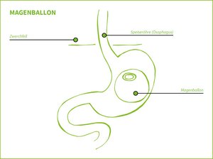 Grafik zeigt Magenballon