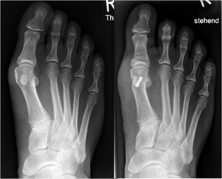 Bild Links: Hallux valgus Deformität. Bild Rechts: Operative Achskorrektur der Großzehe durch eine Chevron- und Akin-Osteotomie.