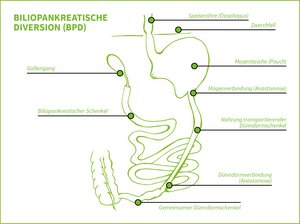 Grafik zeigt bilio-pankreatische Diversion