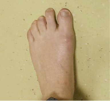 Bild zeigt linken Fuß 3 Monate postoperativ mit guter Achskorrektur