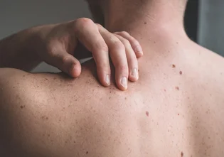 1. Dortmunder Hidradenitis suppurativa-Infoabend