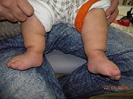 Bild zeigt Füße nach 3 Monaten Schienentherapie
