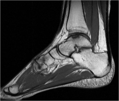 Osteochondrosis dissecans des Sprungbeins (Talus) im MRT.