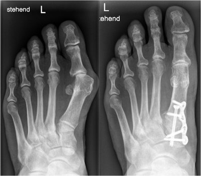 Bild Links: Schwere Hallux valgus Deformität mit starken Beschwerden im Bereich des Großzehenballens. Bild Rechts: Operative, basisnahe Versorgung mit Achskorrektur des 1. Mittelfußknochens und der Großzehe.