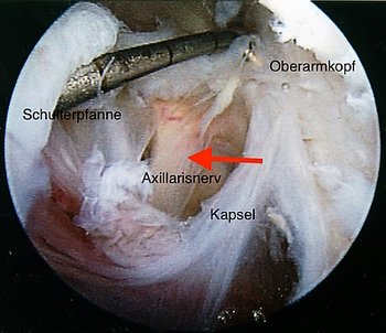 Bild zeigt arthroskopische Darstellung und Entlastung (Neurolyse) des Axillarisnerv (Nervus axillaris) in der rechten Achselhöhle