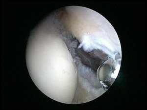 Bild zeigt arthroskopische Operation eines Tennisellenbogens