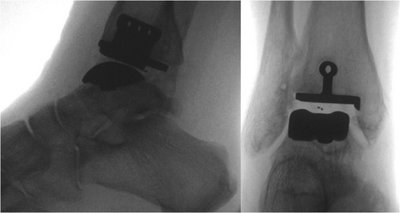 Röntgenbild a.p. und seitlich nach Implantation einer Sprunggelenks- (OSG-) Prothese.
