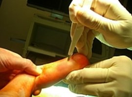 Bild zeigt perkutane Achillessehnentenotomie