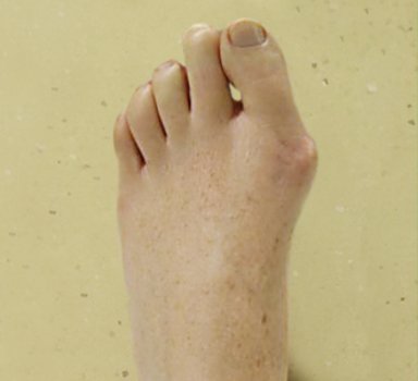 Bild zeigt linken Hallux valgus Fehlstellung linker Fuß präoperativ