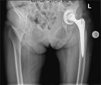 Röntgenbild einer groben Pfannenlockerung mit Dislokation und acetablärem Knochendefekt