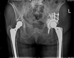 Röntgenbild eines Pfannenabstützring mit Knochentransplantation zum Defektaufbau des Beckens