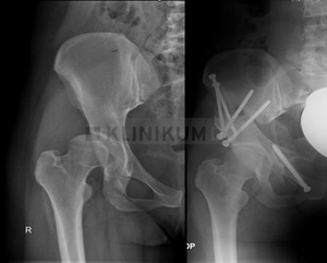 Röntgenbild einer Pat. mit einer Hüftdysplasie vor (links) und nach der Operation (rechts).