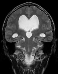 Bild zeigt 2. Röntgenaufnahme eines Schädels / Gehirns