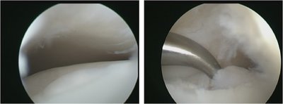 Arthroskopische Mikrofrakturierung des Sprungbeins (Talus) bei umschriebener Osteochondrosis dissecans (Knorpeldefekt).
