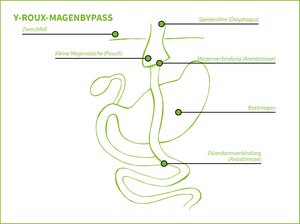 Grafik zeigt Magen-Bypass-Operation