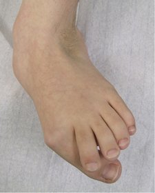 Bild zeigt schwere, kontrakte Knicksenkfuß-Deformität mit ausgeprägtem Hallux valugs