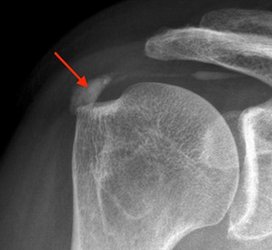 Röntgenbild einer Kalkschulter ( sog. Tendinitis calcarea ) rechts.