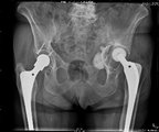 Röntgenbild einer groben Pfannenlockerung mit Dislokation und acetabulärem Knochendefekt