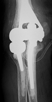 Röntgenbild einer Ellenbogenprothese Röntgenbild einer Ellenbogenprothese, welche nach einer Lockerung des Vorgängerimplantates und einem ehemaligen Unfall eingebaut wurde.