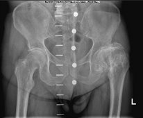 Bild zeigt präop. Planungsbild bei Destruktionscoxarthrose links