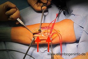 Bild zeigt Operation eines eingeklemmten Medianusnerven beim Pronator teres Syndrom in der rechten Ellenbeuge