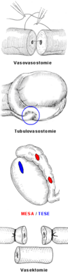 Vasektomie