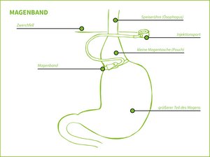 Grafik zeigt Magenband