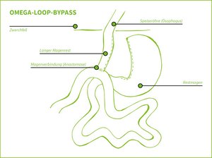 Grafik zeigt Omega-Loop-Bypass („Mini-Bypass”)