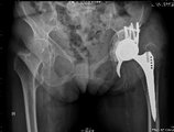 Röntgenbild eines Pfannenabstützring mit tripolarer Pfanne und Knochentransplantation zum Defektaufbau des Beckens