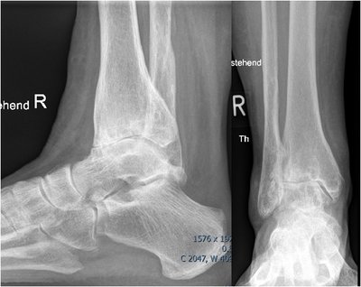 Röntgenbild zeigt fortgeschrittene Arthrose des oberen Sprunggelenks (OSG) mit deutlicher Gelenkspaltverschmälerung.