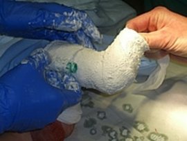 Bild zeigt Gipsanlage mit 70° Abduktion der Füße