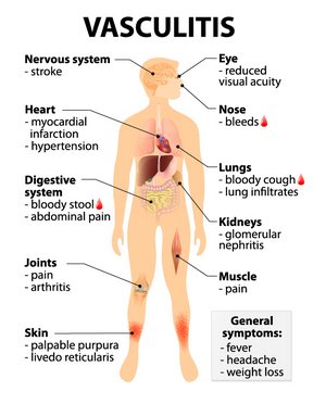 Bild zeigt eine Grafik des menschlichen Körpers mit möglichen Erkrankungen durch Gefäßentzündungen (Vasculitis)