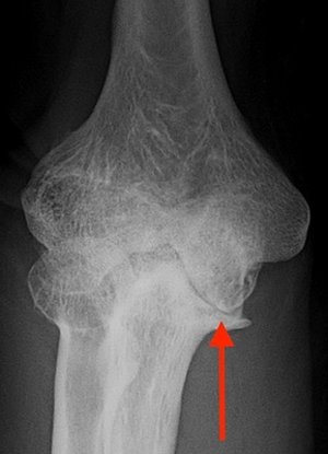 Röntgenbild rechter Ellenbogen: Verschleiß im Ellenbogen
