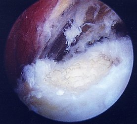 Arthroskopischer Blick auf ein Kalkdepot