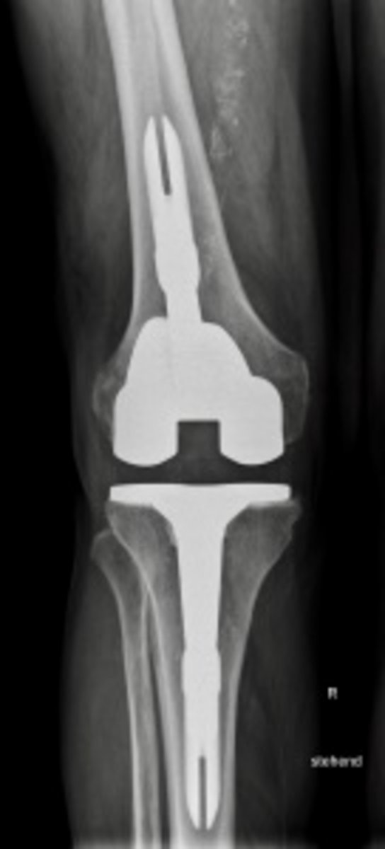 Wechsel/Revisionsendoprothetik des Kniegelenks Orthopädie Klinikum Dortmund Größtes