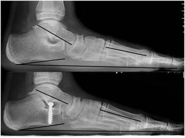 Oben: Röntgenbild eines flexiblen, kindlichen Knicksenkfußes vor der Operation. Unten: Zustand nach subtalarer Talus stopp Arthrorise mit guter Achskorrektur.