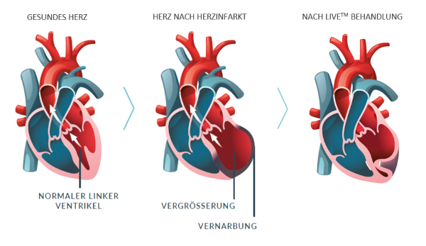 Schematische Darstellung der Herzanatomie und des Krankheitsverlaufes