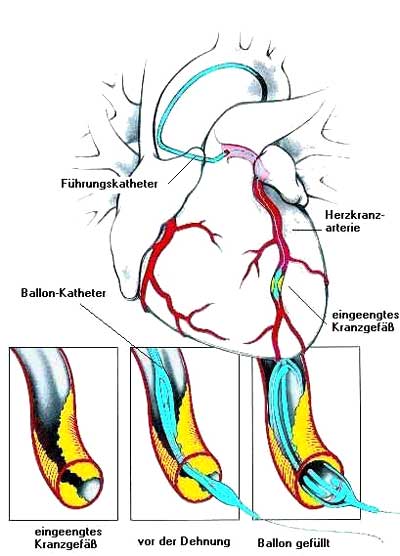 Schema der Koronar-Dilatation