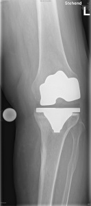 Abbildung 11 Instabilität einer Knieprothese bei Verletzung des Aussenbandes