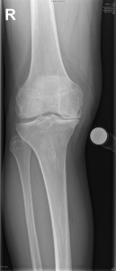 Abbildung 1 isolierte innenseitige Gonarthrose