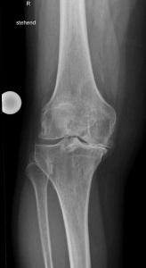 Abbildung 3 Arthrose des gesamten Kniegelenks