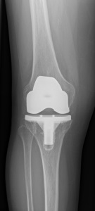 Abbildung 4 Künstliches Kniegelenk zementiert